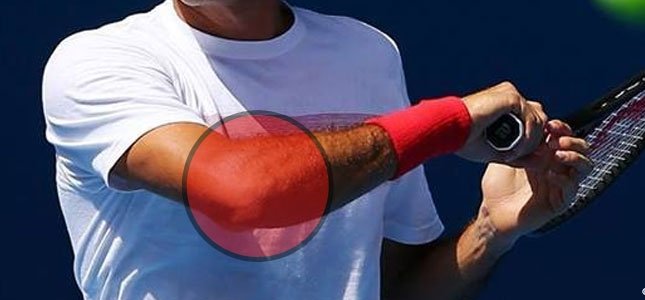 Illustration showing the anatomy of tennis elbow and golfer's elbow, highlighting affected tendons and muscles in the elbow joint.